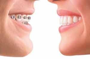 ارتودنسی،بریس،تجهیزات دندانپزشکی